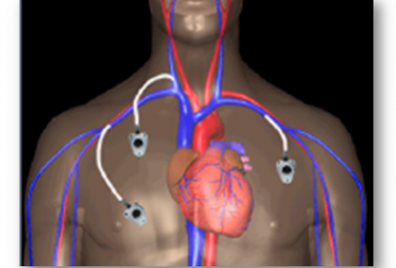 Camera implantabila Celsite - inovatie pentru cresterea calitatii vietii